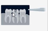 Caries dentales | Recurso educativo 45726